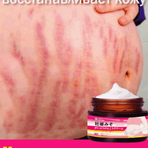 Crème pour les vergetures