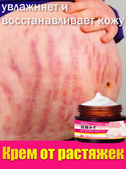 Crème pour les vergetures